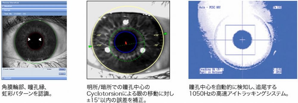 V-Lasik8